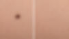 image of mole on woman skin before after laser treatment_edited.jpg