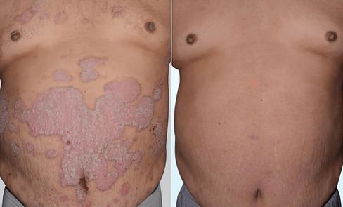 Psoriasis Before & After