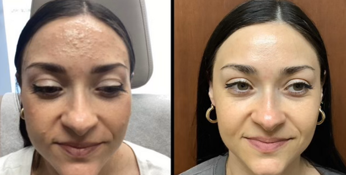 Acne Treatment .png