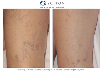 ClearV-leg-veins-bA-Dr.-Campo.jpg