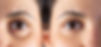 lower blepharoplasty_ before and after treatment.jpg
