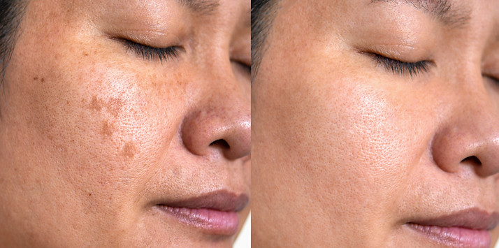 Image before and after spot melasma pigmentation facial treatment on middle age asian woma
