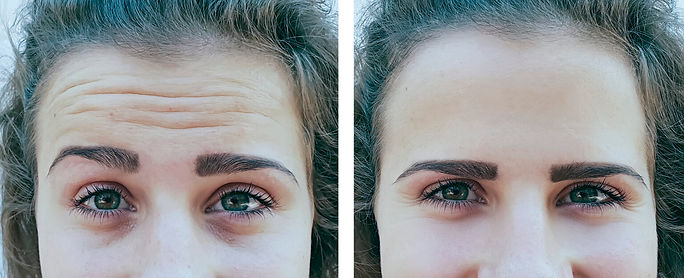 botox1.jpg