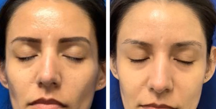 Sculptra.png