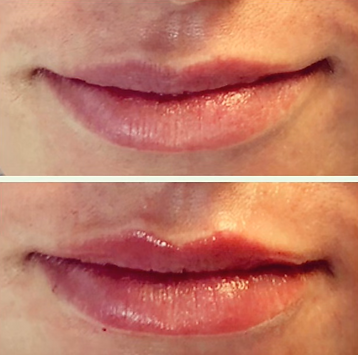 Lip Filler.png