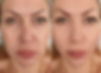 woman face wrinkles before and after treatment.jpg