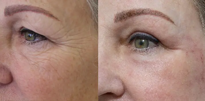 Laser-Resurfacing-Erbium.webp
