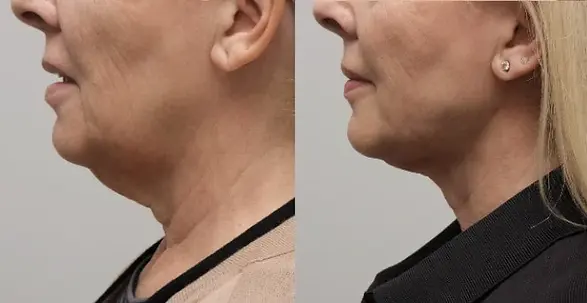facetite-before-after-4.webp