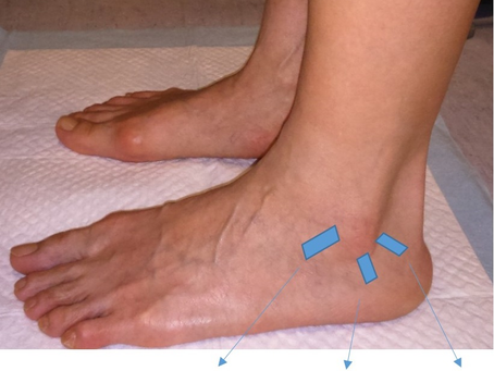 Ankle Sprain 足踝扭傷 (俗稱「拗柴」)