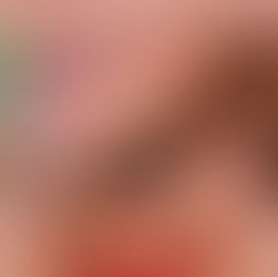 How Long Do Veneers Last? What Really Affects Veneer Longevity