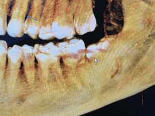 Wisdom Tooth Surgery in Kuala Lumpur: A Comfortable, Stress-Free Experience (2026 Guide)