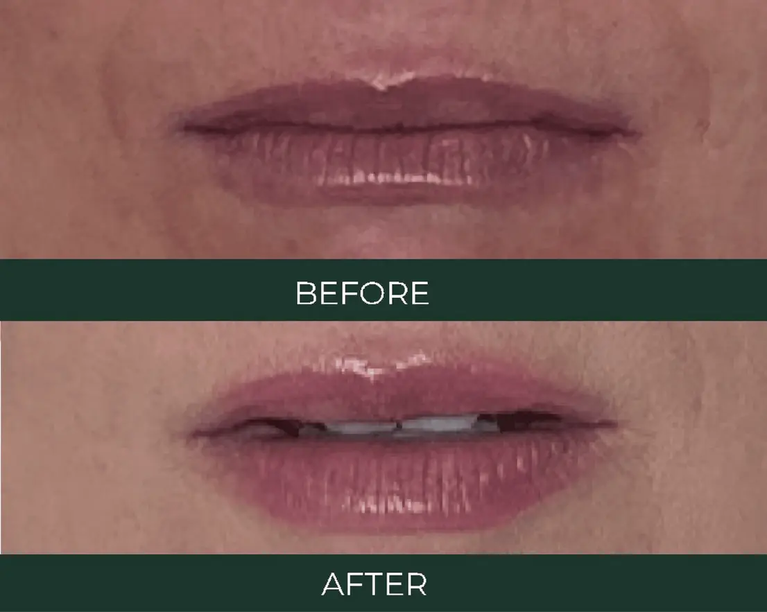 Cheek filler before and after results at Simply You Med Spa in Evergreen and Conifer, Colorado