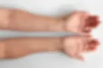 Spider vein solutions at Simply You Med Spa, Evergreen & Conifer.