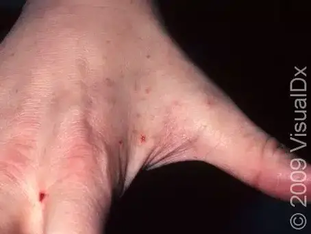 Uyuz hastalığı Skabiyez hakkında bilgilendirme Kağan Cingöz Dermatoloji Uzmanı Kırklareli