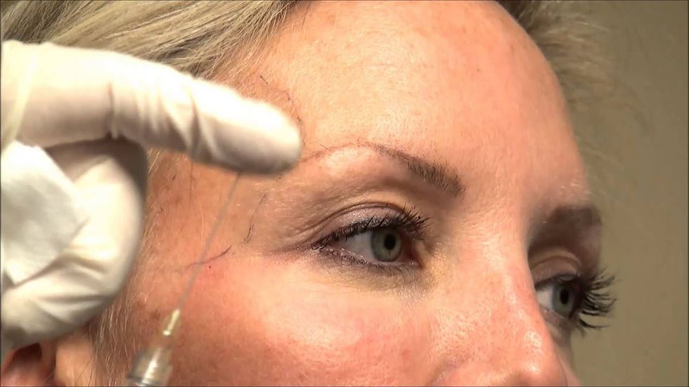 Temporal (şakak) dolgusu Kırklareli , Edirne, Lüleburgaz, temporal dolgu çorlu , şakak dolgusu edirne, temporal dolgu edirne, kırklareli dolgu, edirne dolgu, lüleburgaz dolgu , kaş kaldırma dolgusu, temporal dolgu kırklareli , şakak dolgusu kırklareli, temporal dolgusu lüleburgaz, şakak dolgusu edirne, kağan cingöz dermatolog, temporal dolgu fiyatları