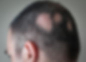 Γυροειδής αλωπεκία (alopecia areata): αίτια, πιθανότητα επαναφοράς και τεκμηριωμένη θεραπεία