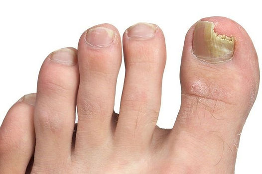 Fungal nail in need of treatment