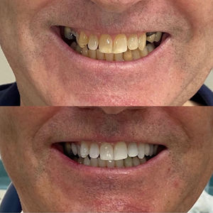 Before & After dental work