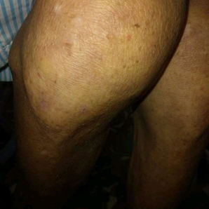 VISTO EN REDES: Más de 165 ancianos que viven en un hogar en Manzanillo, Granma, padecen desde hace meses una grave infestación de chinches,