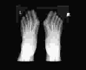 Xray Bunions