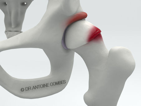 LE CONFLIT DE HANCHE, UNE BLESSURE DE SOUPLESSE !