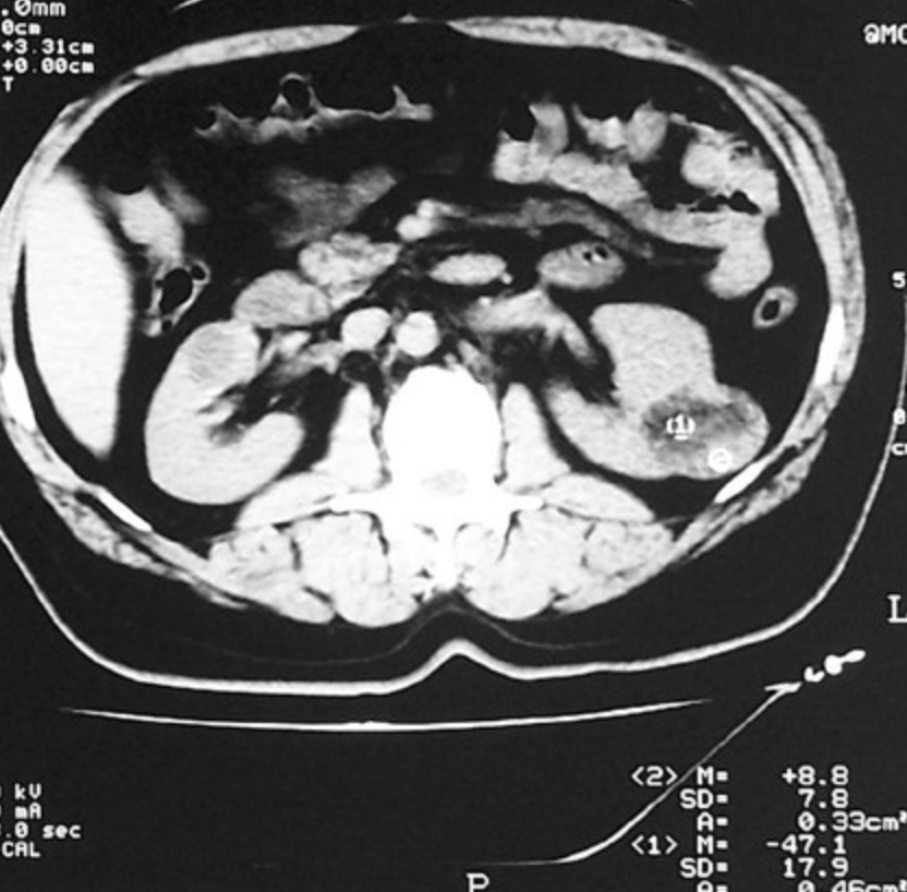 Angiomyolipome = graisse