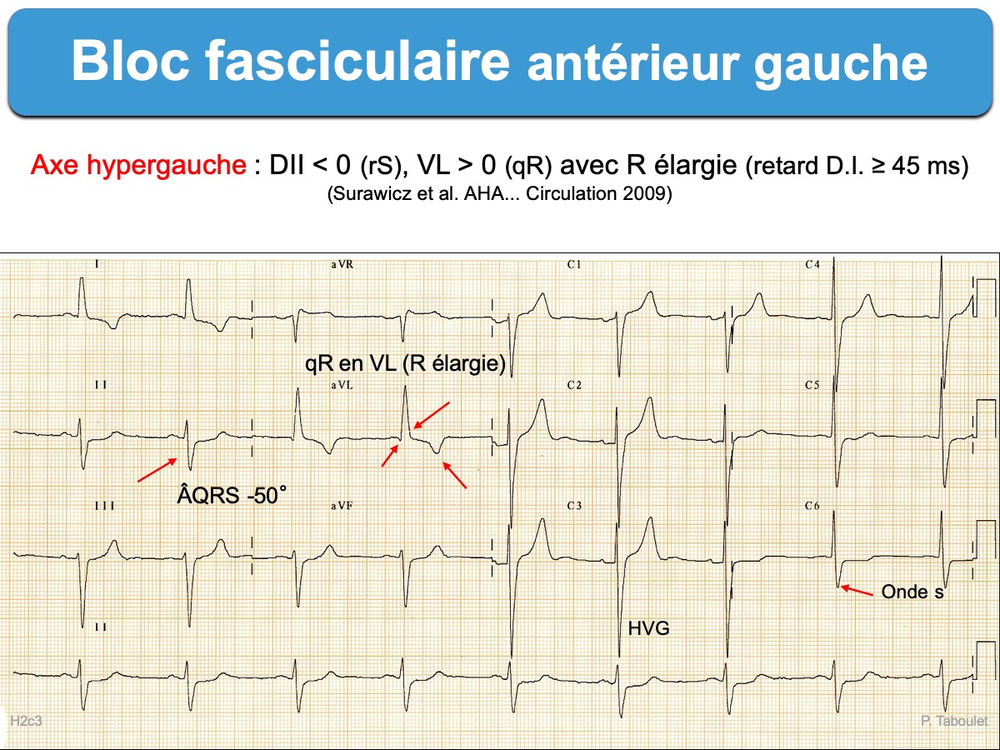 Aiguillage droit à gauche coeur conducteur - voie Profi N - FLEISCHMANN 9178 Aiguillage droit à gauche coeur conducteur - voie Profi N - FLEISCHMANN 9178