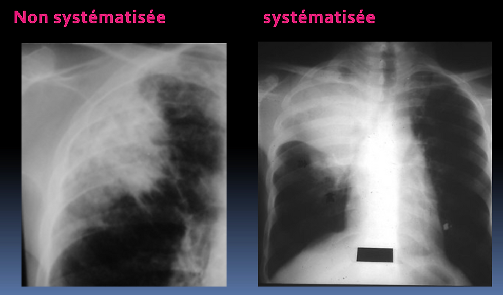 Pneumonie alvéolaire = Opacité Systématisée = PAC