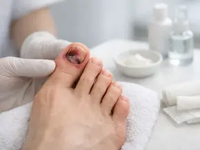 Uña traumatizada pie: tratamiento y cuidados