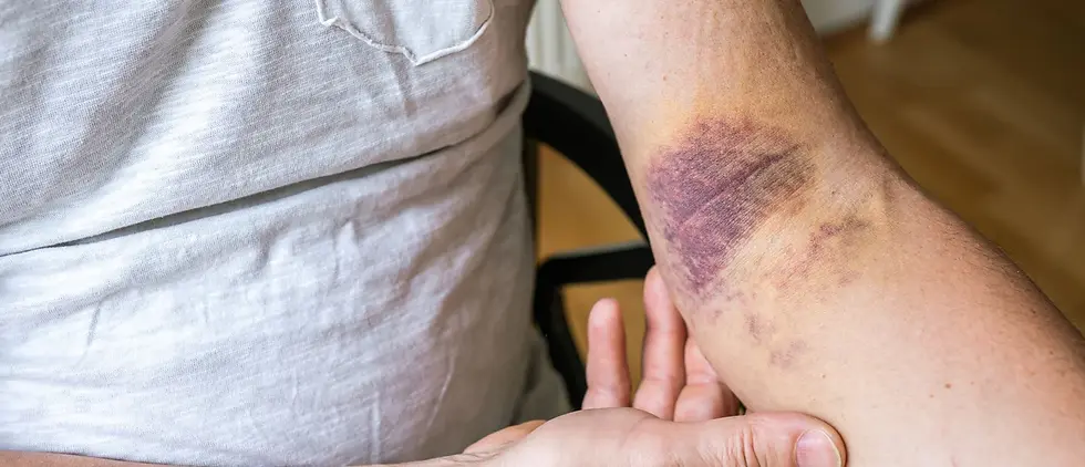 badly bruised arm