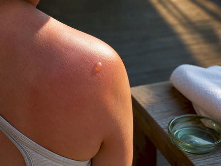 Intact blister on sunburned shoulder