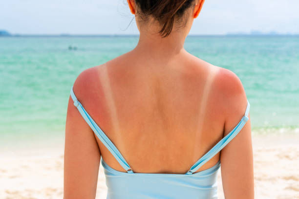 Girl with sunburn on shoulders and back