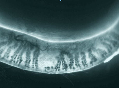 meibomian gland dysfunction.jpg