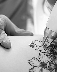 tattoo-removal_edited.jpg