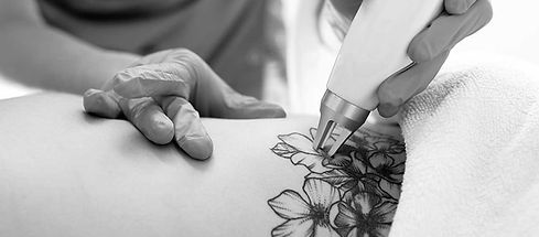 tattoo-removal_edited.jpg