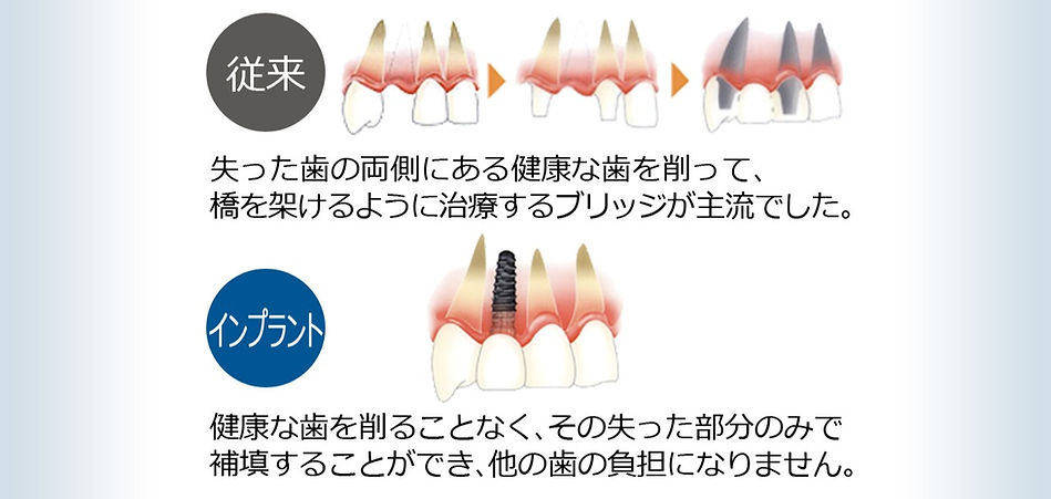 歯科医院 インプラント