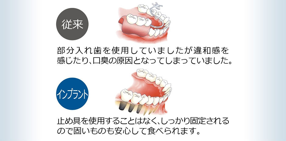 インプラント専門