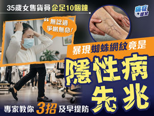 35歲女售貨員突然暴現蜘蛛網紋揭隱性靜脈問題