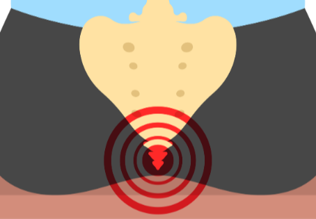 Understanding and Dealing with Tailbone Pain