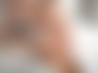 Woman receiving professional dermatological treatment at a medical clinic for rolling scar improvement