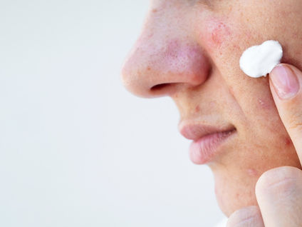 Close-up of a woman applying cream to her cheek with visible post-inflammatory erythema caused by acne, illustrating skincare treatment for acne-related redness.