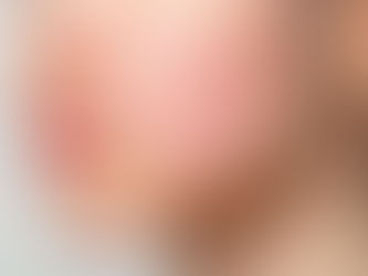 Woman with facial redness on cheeks, illustrating how to reduce redness on face