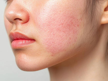 Woman with facial redness on cheeks, illustrating how to reduce redness on face