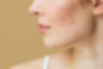 Side profile of a fair-skinned woman with clear skin showing post-inflammatory erythema (redness) and post-inflammatory hyperpigmentation (brownish spots) on her cheek against a beige background, illustrating the difference between PIE and PIH and their treatment.