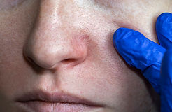Rosacea Nose Treatment: Guide to Options and Daily Care