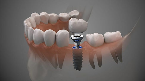 Implant.jpeg