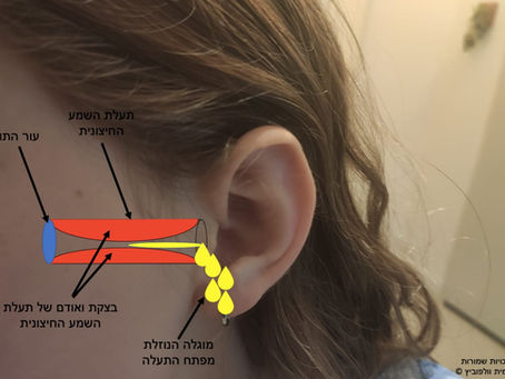 הקיץ בשיאו ודלקת האוזן החיצונית כאן. הטיפול בדלקת אוזן חיצונית חריפה (Acute Otitis Externa)