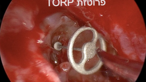 שחזור עצמימות השמע - אוסיקולופלסטי (ossiculoplasty)