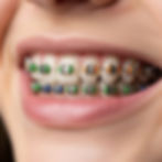 brackets-metalicos-con-ligas-de-colores-en-tus-tratamientos-de-ortodoncia-en-ortho-dental-