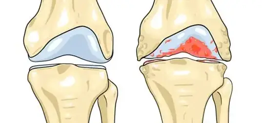 arthrose-genou-1.webp